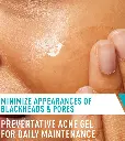 Acne-Control-Gel-Apply-desktop-700x785-v1.webp